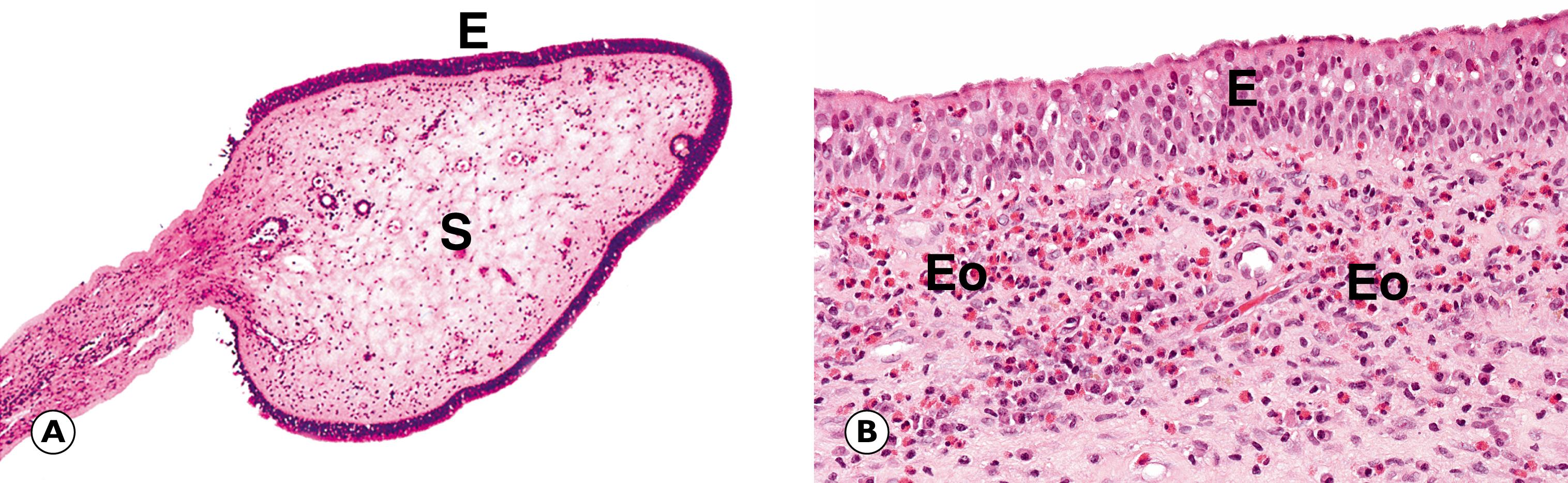 Fig. 12.1, Nasal polyps. (A) LP; (B) HP.