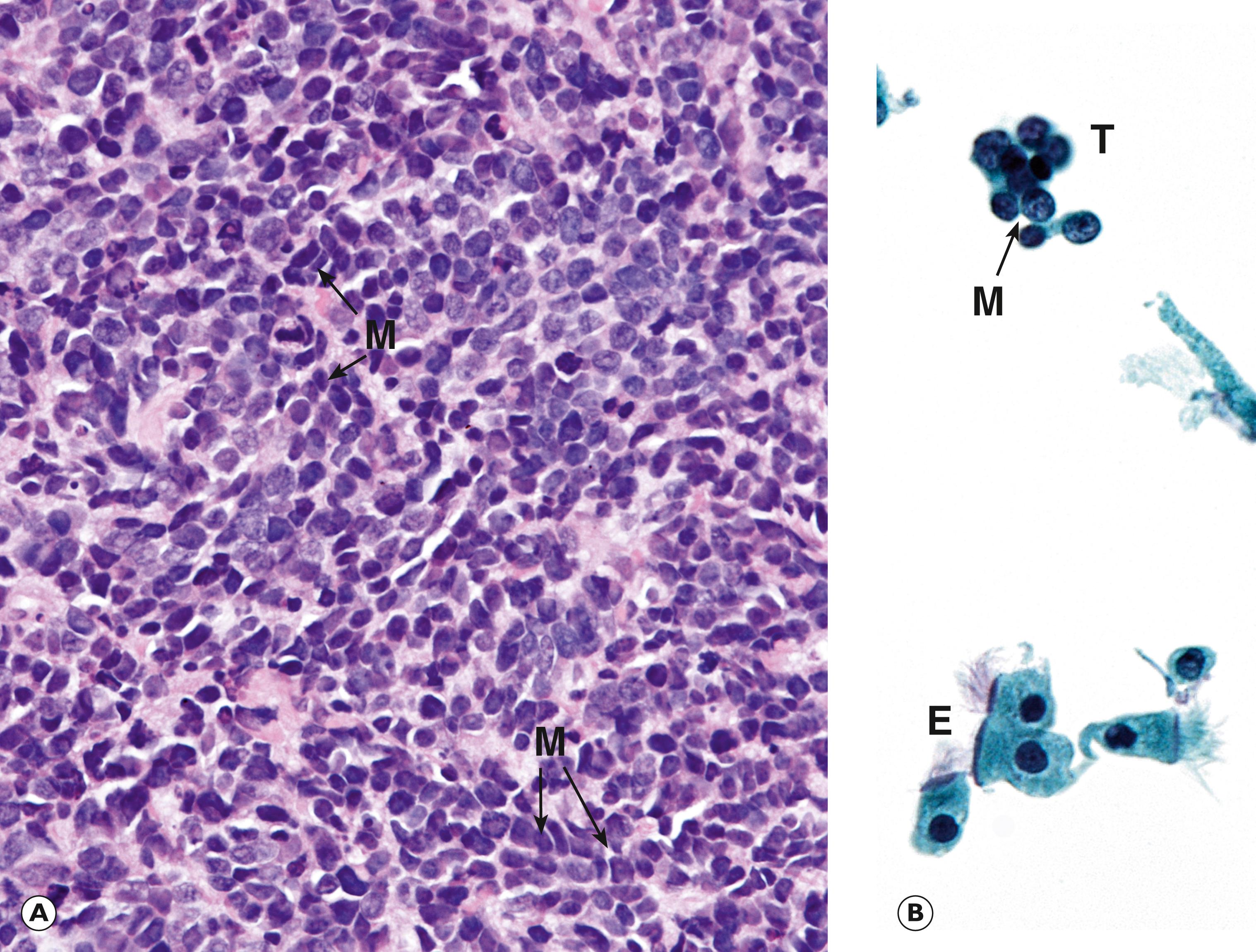 Fig. 12.17, Small cell carcinoma. (A) Biopsy (HP); (B) cytology (Papanicolaou stain, HP).