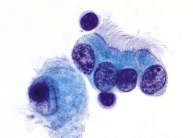 Fig. 2.1, Normal Ciliated Bronchial Cells (Bronchial Brushing).