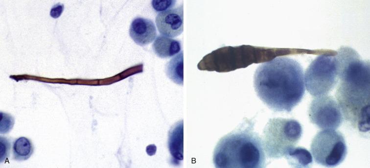 Fig. 2.13, Alternaria (Bronchoalveolar Lavage).