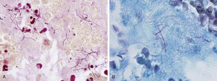 Fig. 2.14, Nocardia (Bronchoalveolar Lavage).