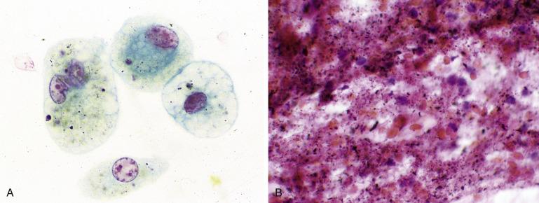 Fig. 2.2, Anthracotic Pigment and a Mimic (Black Particles).