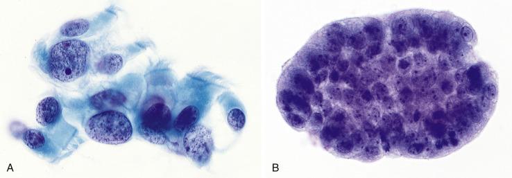 Fig. 2.4, Reactive Bronchial Cells.