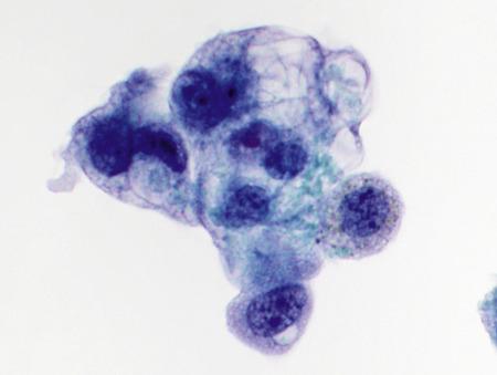 Fig. 2.7, Type II Pneumocyte Hyperplasia (Bronchoalveolar Lavage).