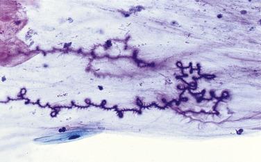 Fig. 2.8, Curschmann’s Spiral (Sputum).