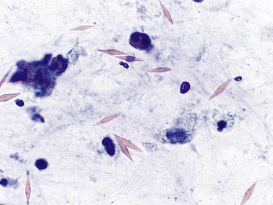 Fig. 2.10, Charcot–Leyden Crystals (Bronchial Washing).