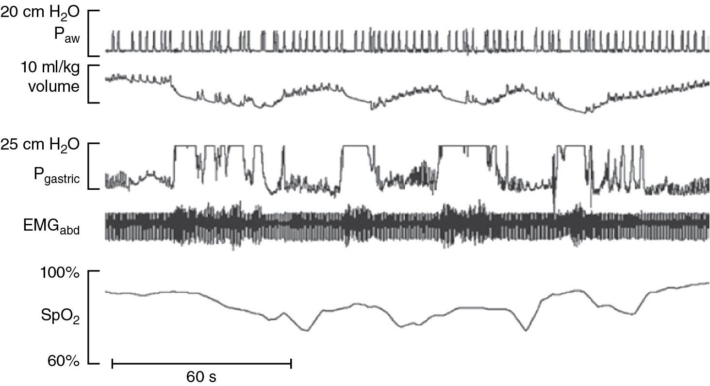 Fig. 8.1, Mechanism triggering an episode of hypoxemia in a ventilated infant.