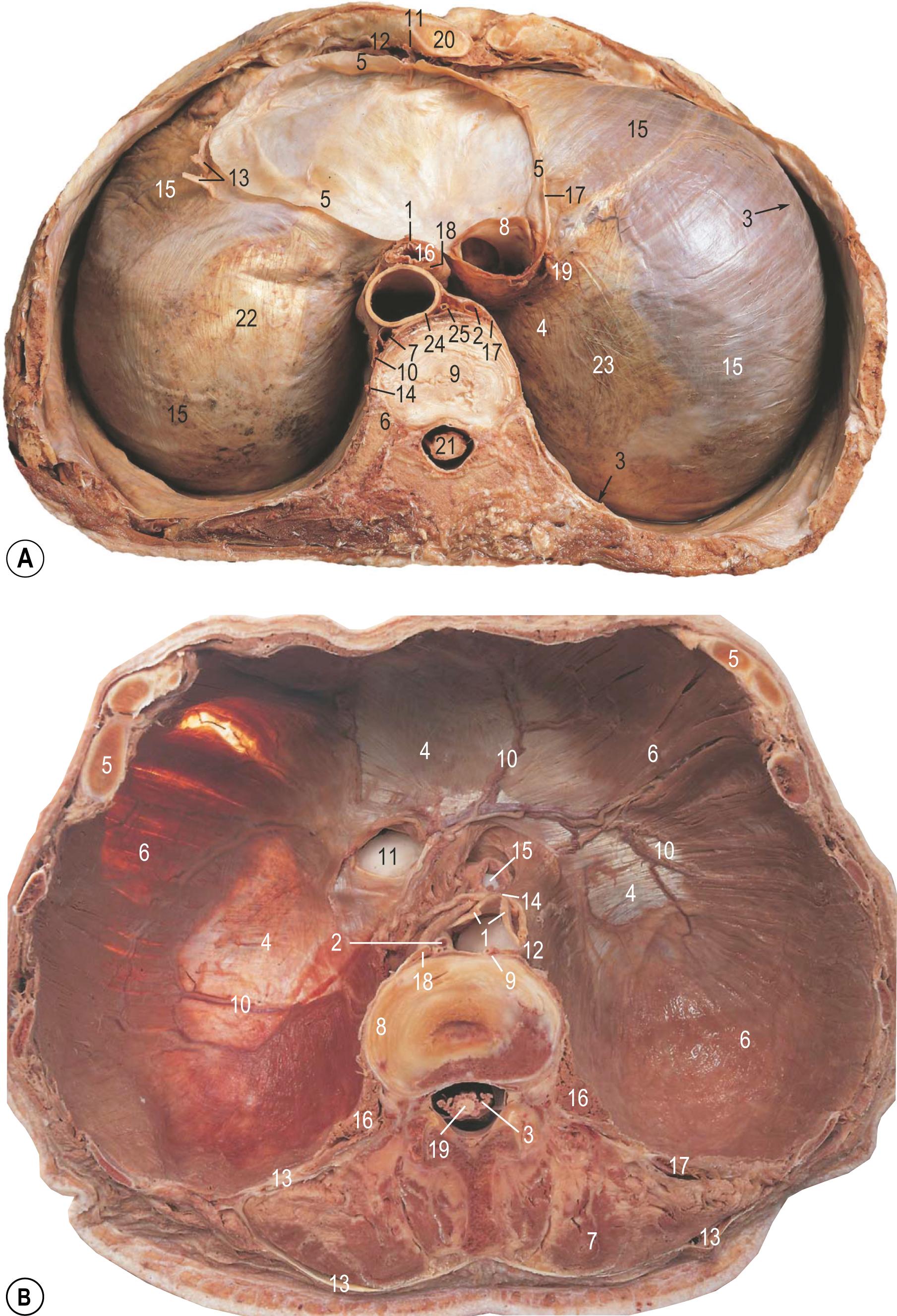 Fig. 55.3, Superior and inferior views of the respiratory diaphragm. A , Superior view showing the relationship between the central tendon and muscular components, and the prominent relationship between the diaphragm and the pericardium. Key: 1, anterior oesophageal plexus; 2, azygos vein; 3, costodiaphragmatic recess; 4, costomediastinal recess; 5, fibrous pericardium (cut edge); 6, head of left rib 9; 7, hemiazygos vein; 8, inferior vena cava; 9, intervertebral disc; 10, left greater thoracic splanchnic nerve; 11, left internal thoracic artery; 12, left musculophrenic artery; 13, branches of the left phrenic nerve; 14, left sympathetic trunk; 15, muscle of diaphragm; 16, oesophagus; 17, mediastinal parietal pleura (cut edge); 18, posterior oesophageal plexus; 19, right phrenic nerve; 20, seventh left costal cartilage; 21, spinal cord; 22, left folia of central tendon; 23, right folia of central tendon; 24, descending thoracic aorta; 25, thoracic duct. B , Inferior view showing muscular fibres attaching onto the central tendon, and associated openings and vasculature. Key: 1, abdominal aorta; 2, azygos vein; 3, cauda equina; 4, central tendon of the diaphragm; 5, costal cartilage (cut); 6, muscle of the diaphragm; 7, erector spinae muscle group; 8, L1–L2 intervertebral disc; 9, hemiazygos vein; 10, inferior phrenic vessels; 11, caval foramen; 12, left crus of respiratory diaphragm; 13, thoracolumbar fascia; 14, median arcuate ligament; 15, oesophagus (abdominal part); 16, psoas major; 17, quadratus lumborum; 18, right crus of respiratory diaphragm; 19, spinal cord.