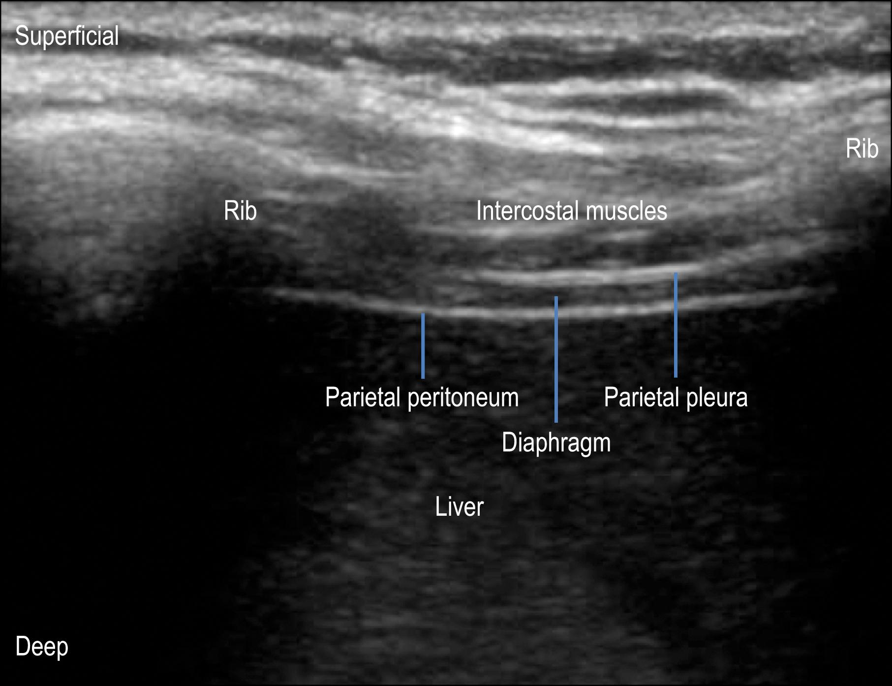 Fig. 55.4, Ultrasound of the respiratory diaphragm at the level of the eighth left intercostal space in the midaxillary line. The diaphragm is visualized as a hypoechoic (dark) line sitting between two hyperechoic (light) layers consisting of the parietal peritoneum and the parietal pleura.