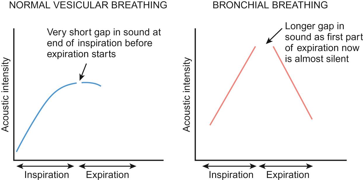 Fig. 17.6, Schematic representation of bronchial and vesicular breathing.