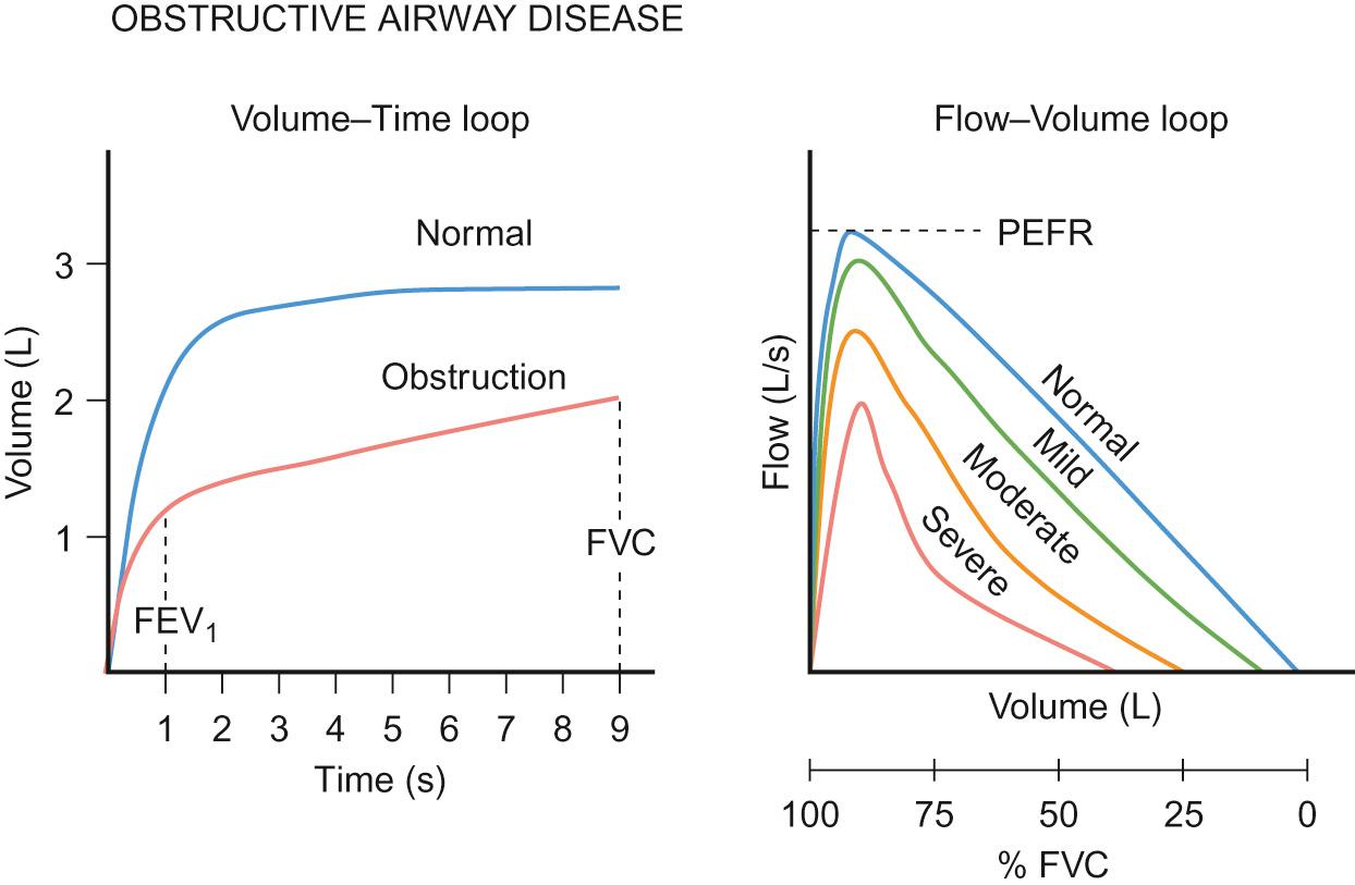 Fig. 17.8, Typical volume–time and flow–volume loops in obstructive airway disease. In obstruction, flow is reduced compared to normal values (or the personal best value of the child measured previously), but there is relative preservation of the total lung volume. Thus, FEV 1 is reduced more, as a proportion of the expected value, than the FVC.