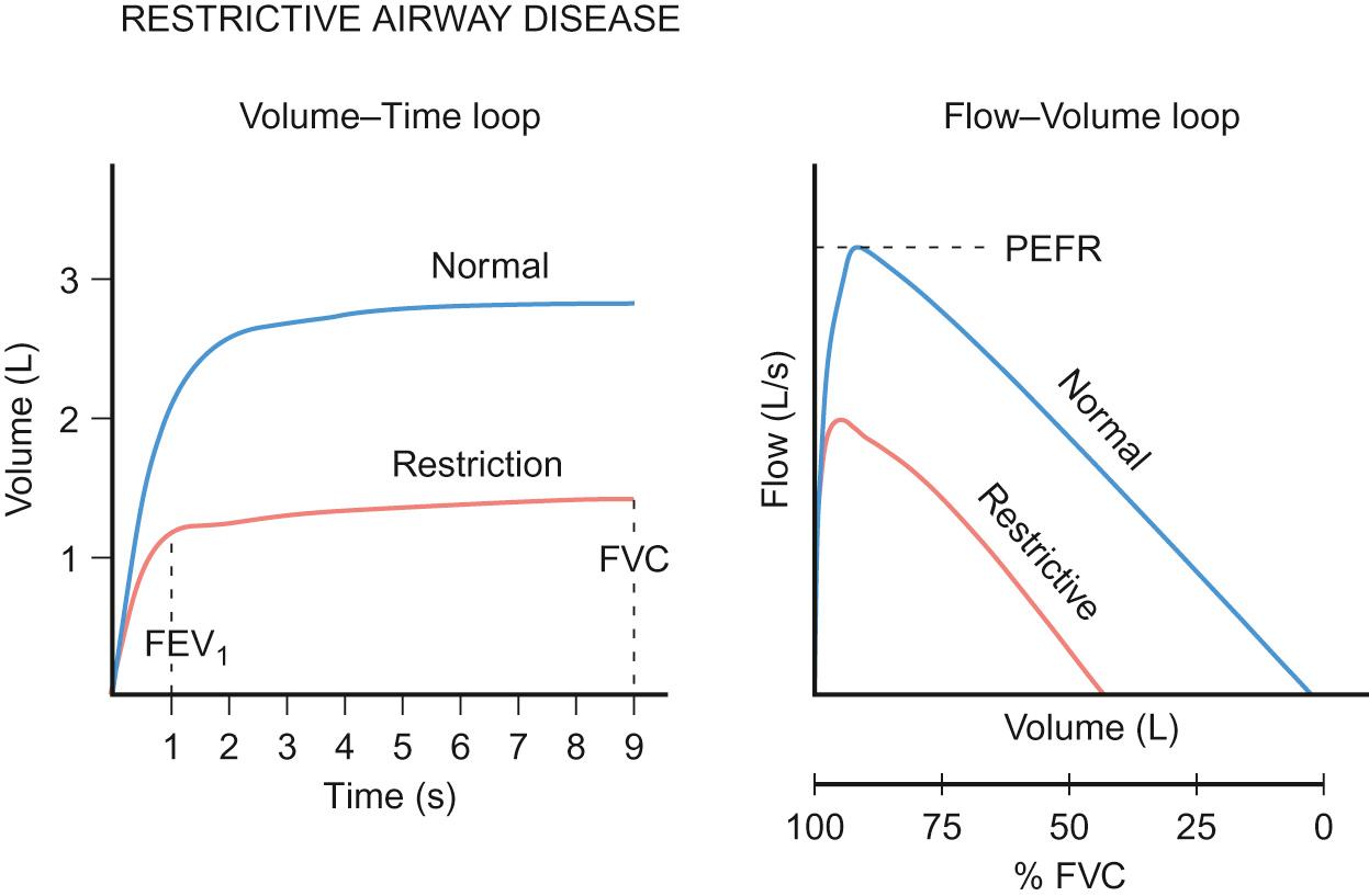 Fig. 17.9, Typical volume–time and flow–volume loops in restrictive airway disease.