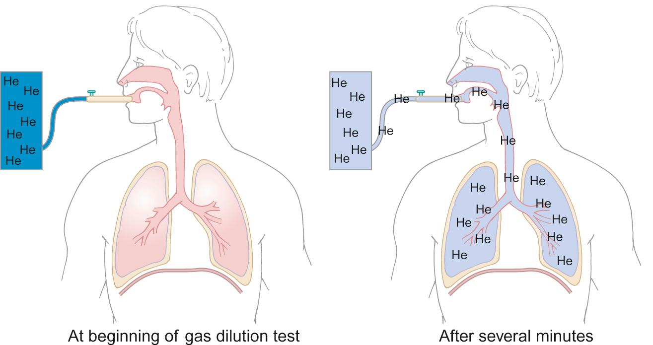 Fig. 17.10, Principles of the gas dilution technique. Gas dilution is a method of determining those lung volumes that cannot be determined from spirometry. The subject is connected to a spirometer containing a known concentration of helium, or other inert and insoluble gas. After several minutes of breathing, gas concentrations in the lung and spirometer equilibrate. From the law of conservation of matter, we know that the total amount of helium before and after is the same. Therefore, the fractional concentration × the volume before = the final fractional concentration × the volume.