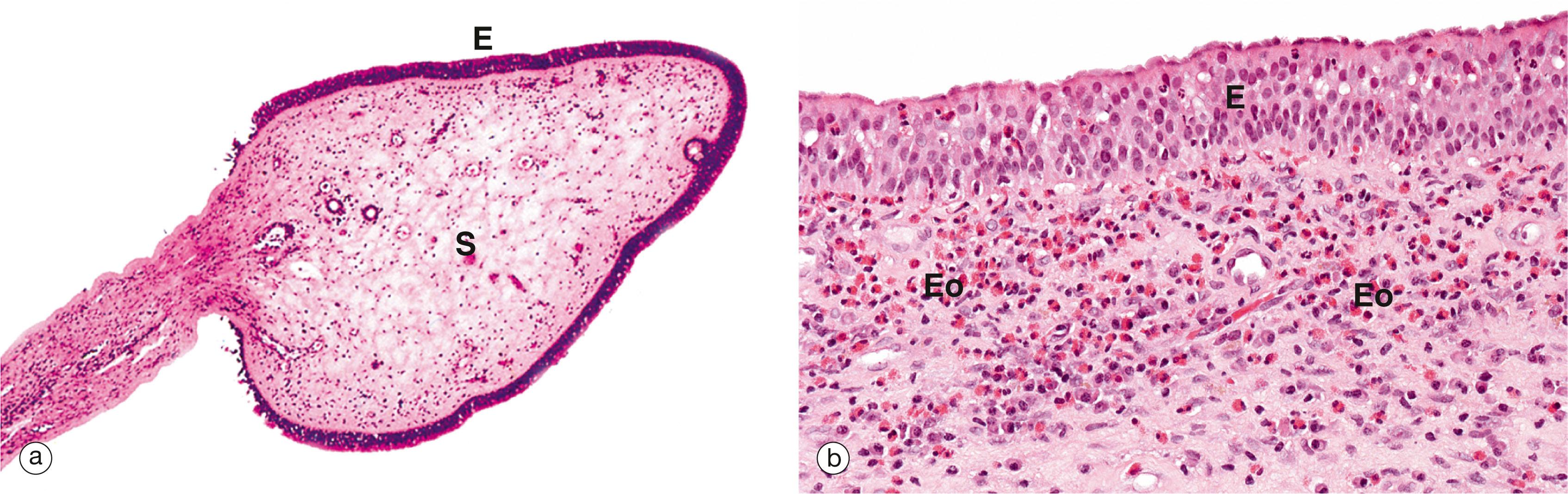 E-Fig. 12.1, Nasal polyps