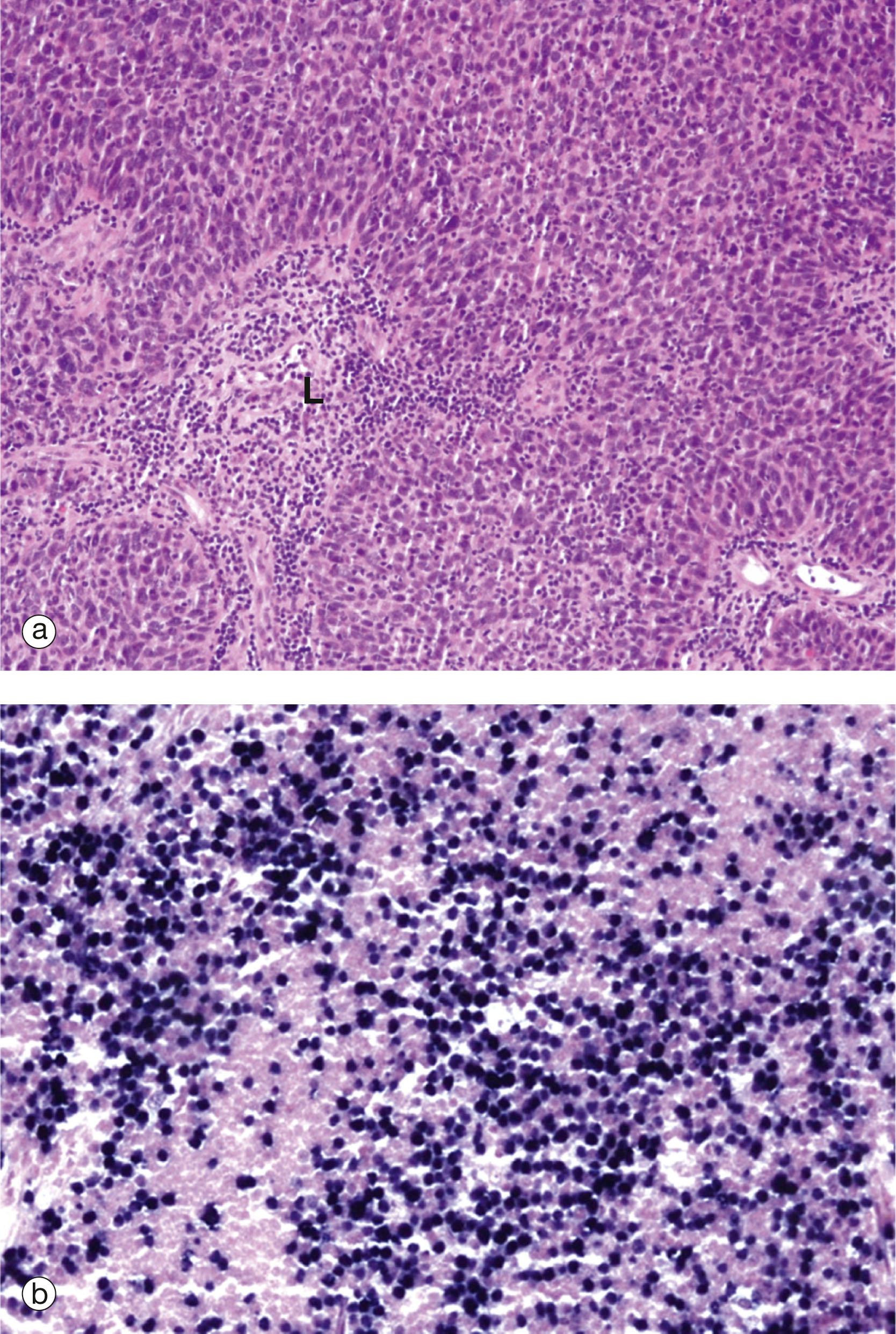 E-Fig. 12.2, Nasopharyngeal carcinoma