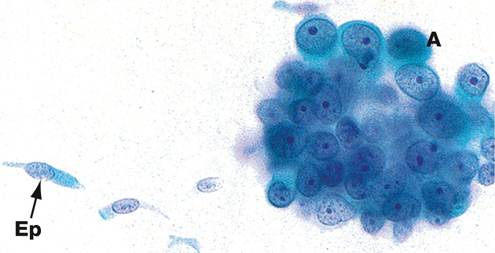 Fig. 12.20, Lung cancer cytology FNA sample