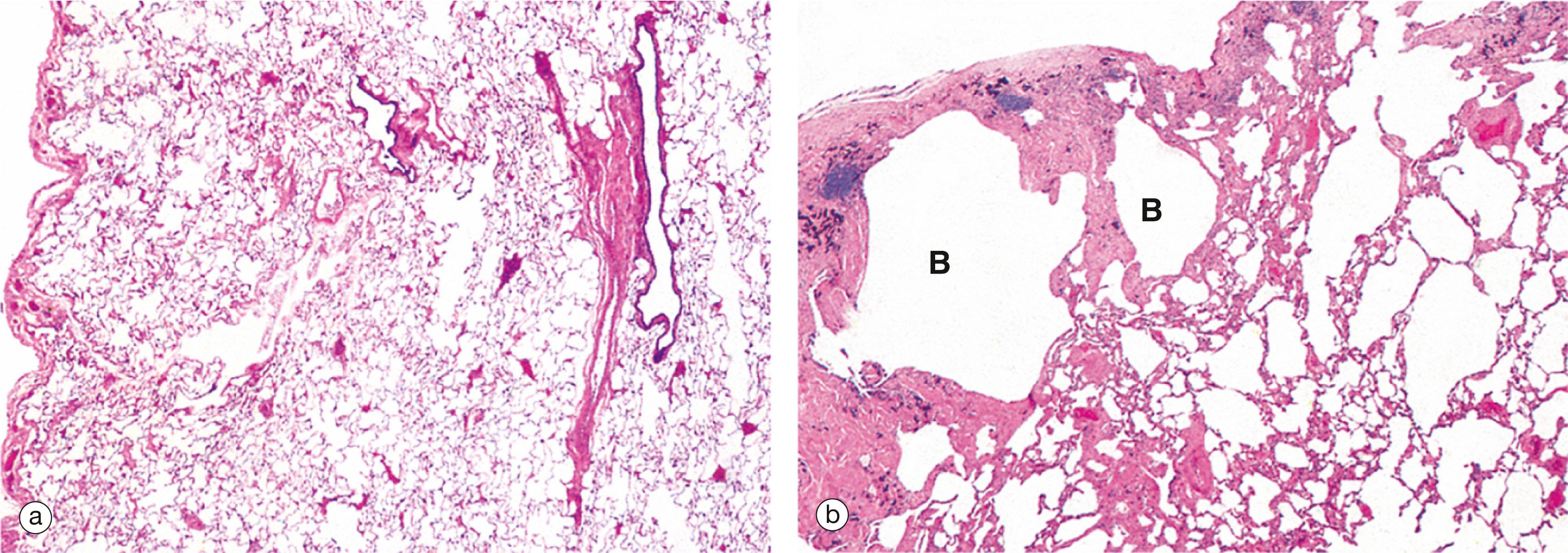 E-Fig. 12.5, Pulmonary emphysema