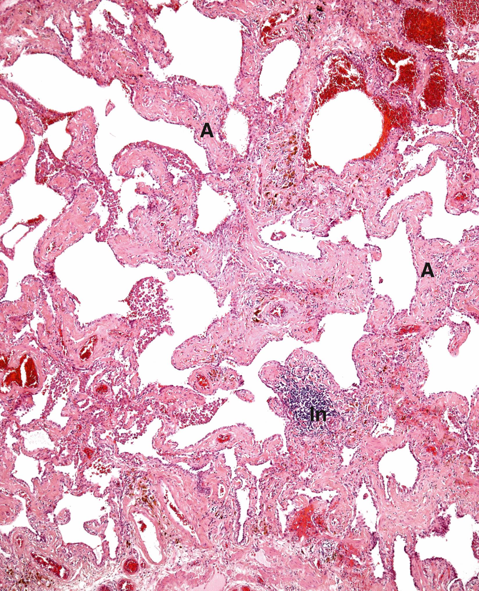 E-Fig. 12.6, Pulmonary fibrosis (LP)