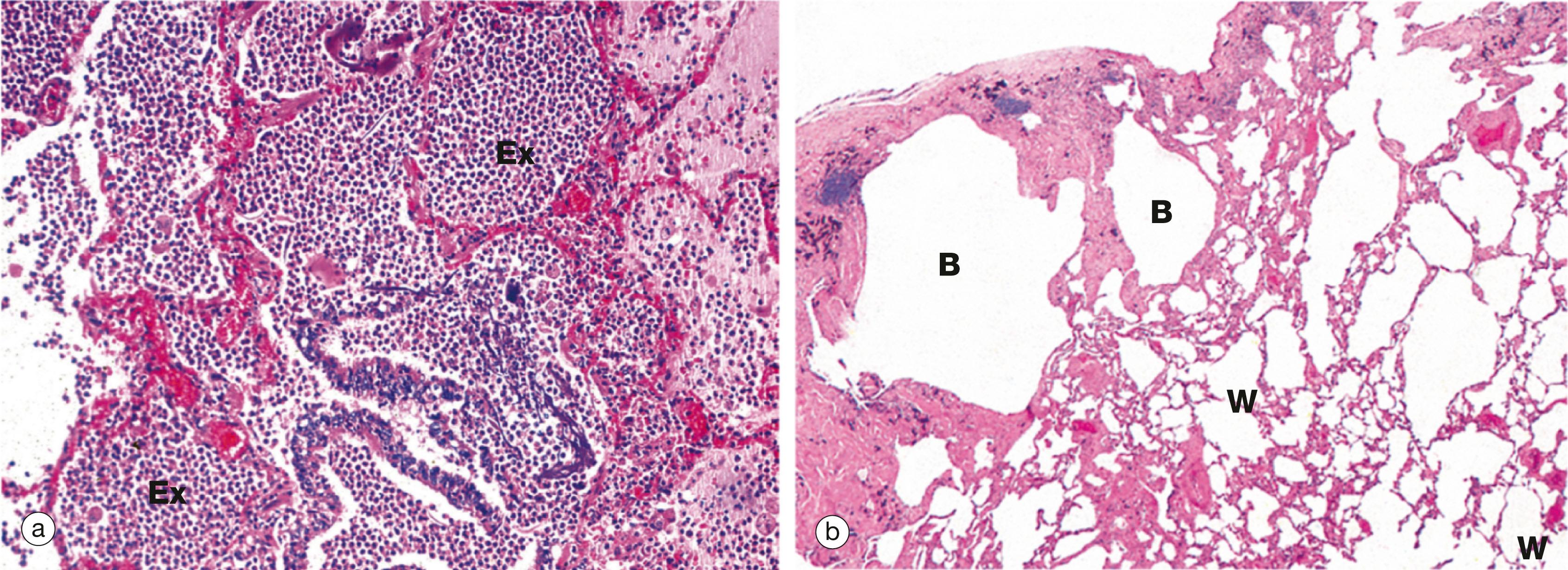 Fig. 12.19, Common lung pathology