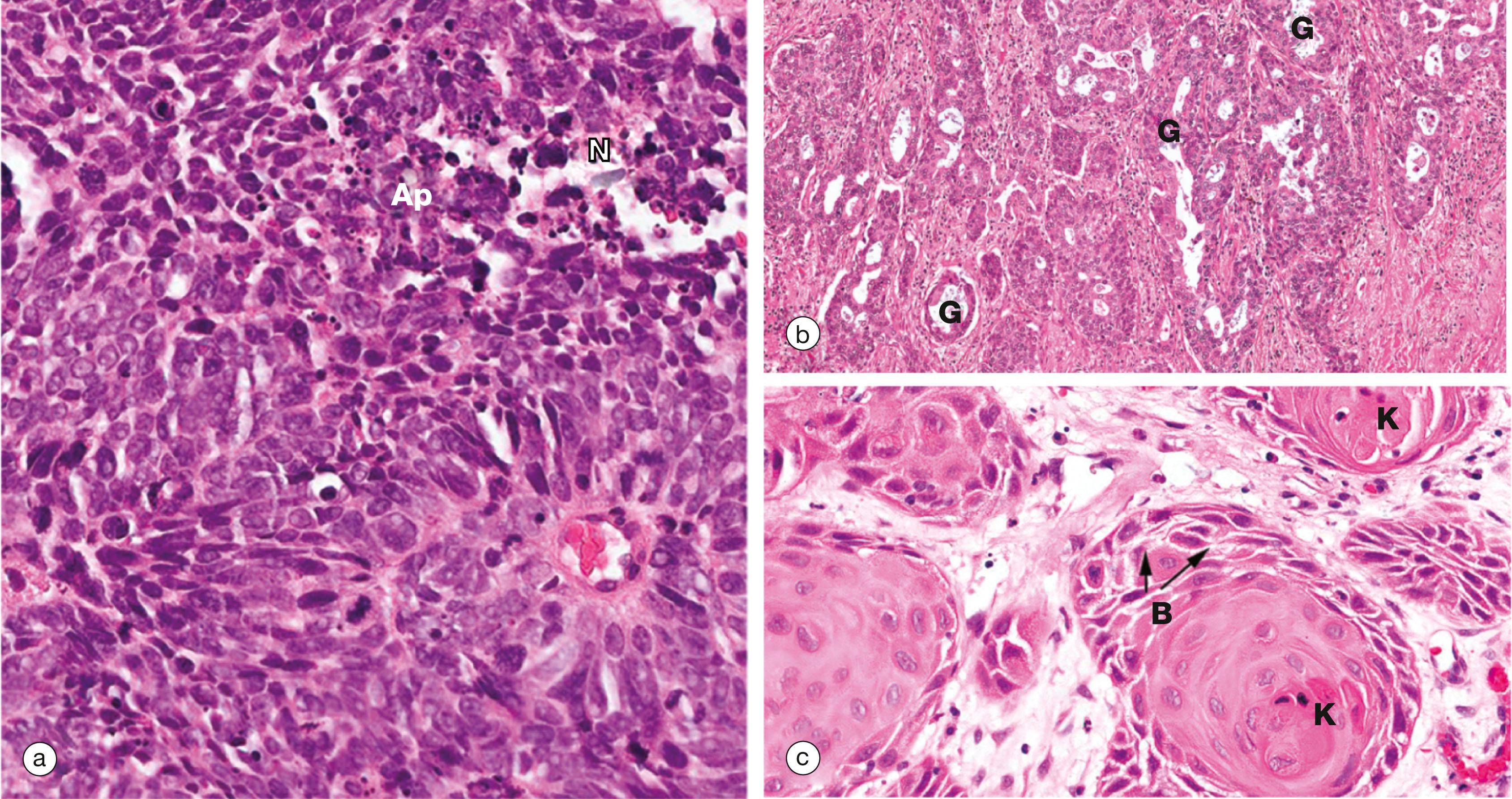 Fig. 12.21, Types of lung cancer