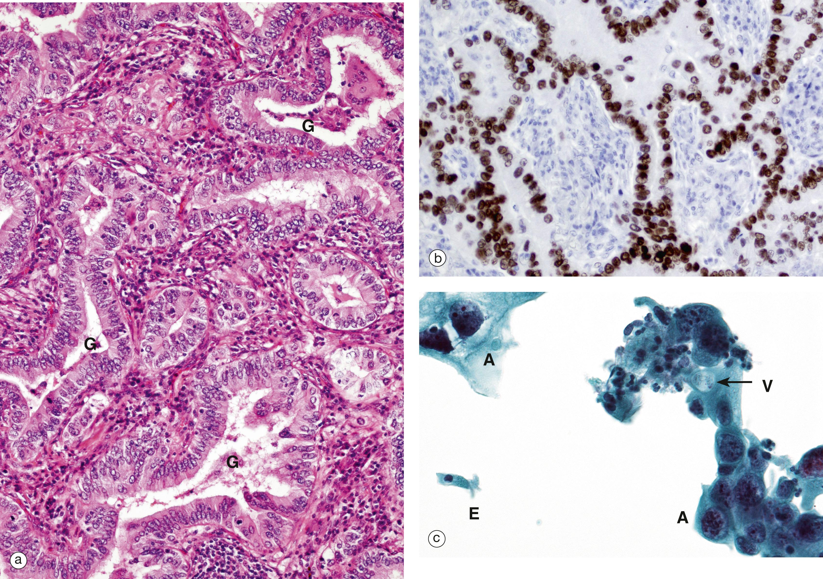 E-Fig. 12.10, Adenocarcinoma of the lung