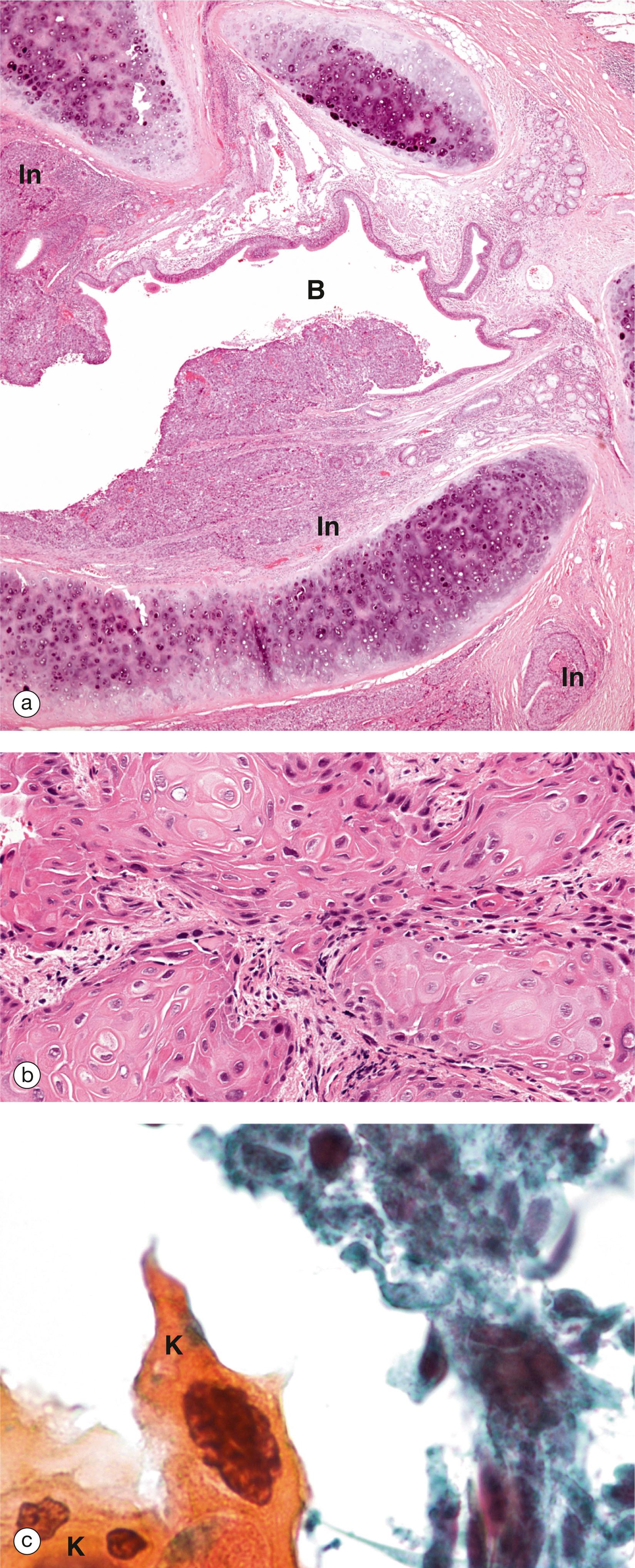 E-Fig. 12.11, Squamous cell carcinoma of bronchus