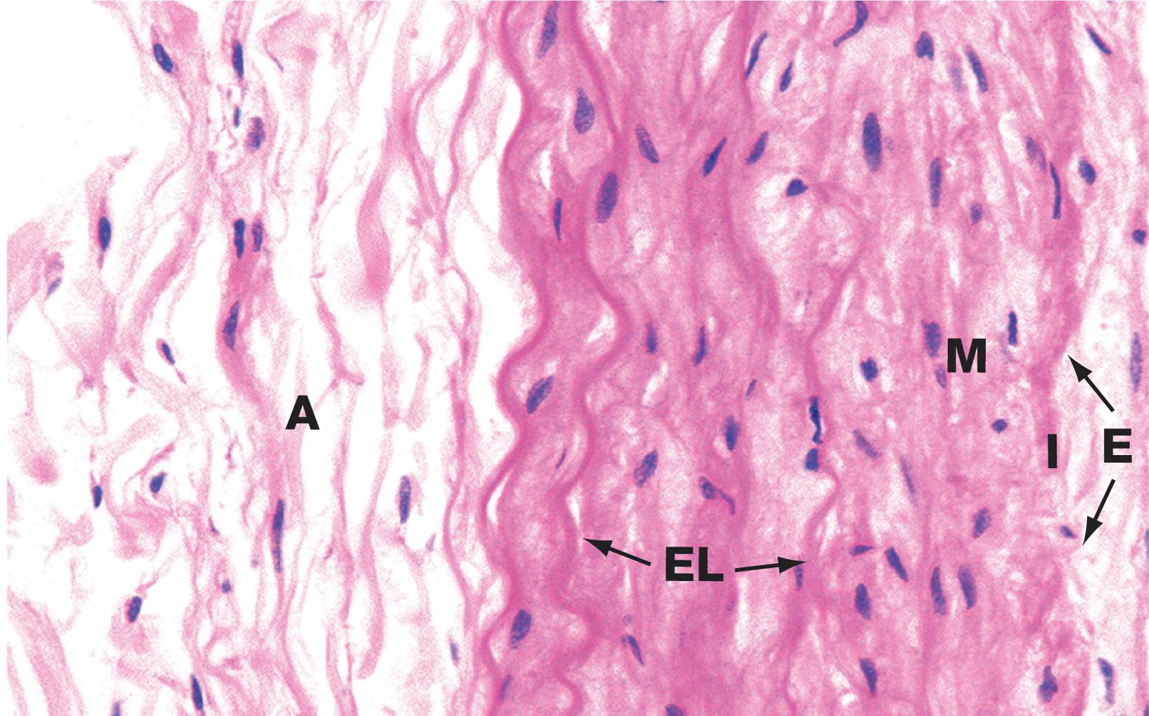 Fig. 12.22, Large pulmonary artery