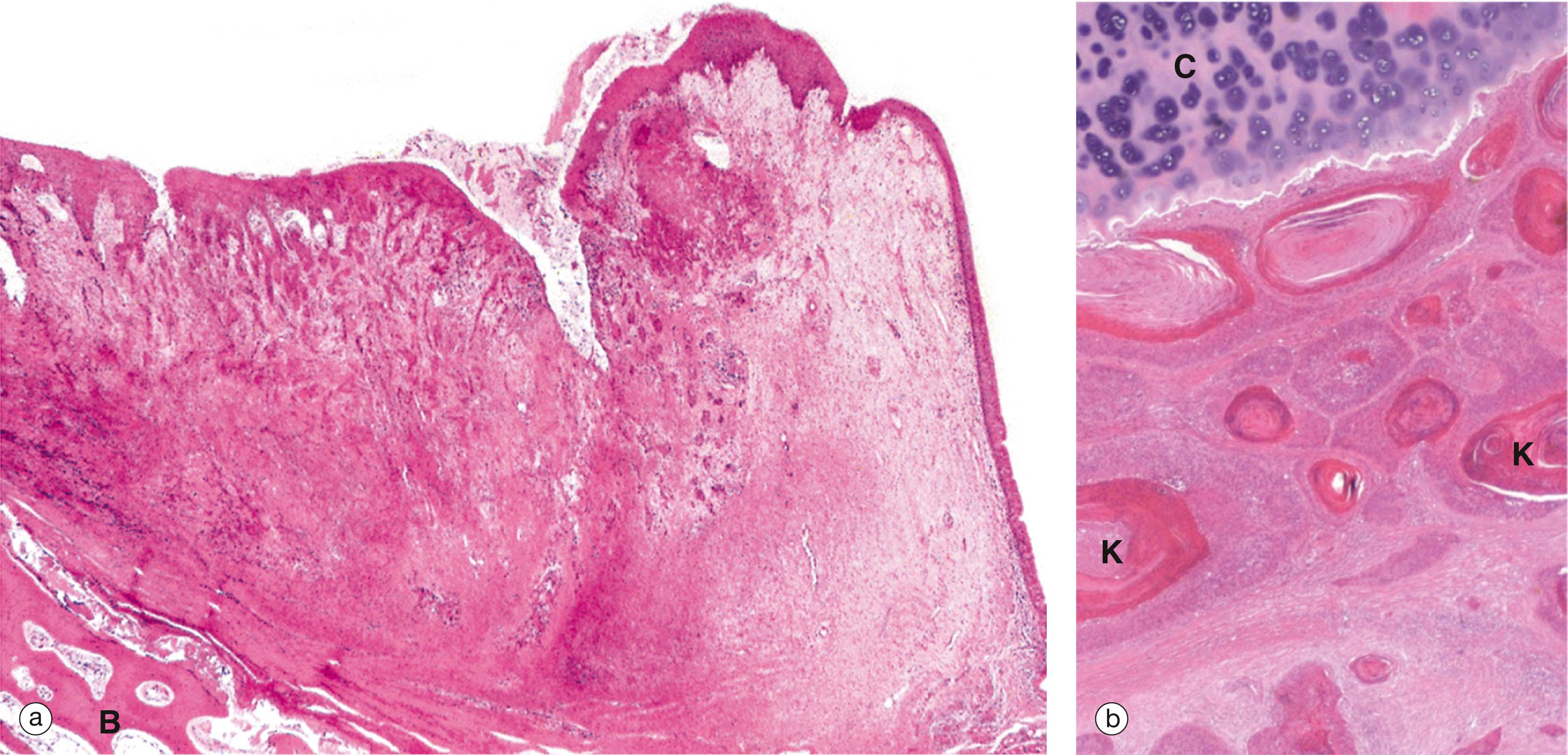 E-Fig. 12.3, Squamous carcinoma of the larynx