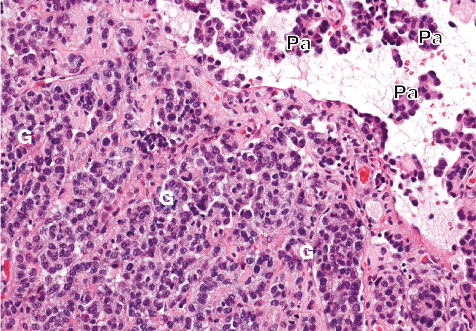 Fig. 12.25, Malignant mesothelioma