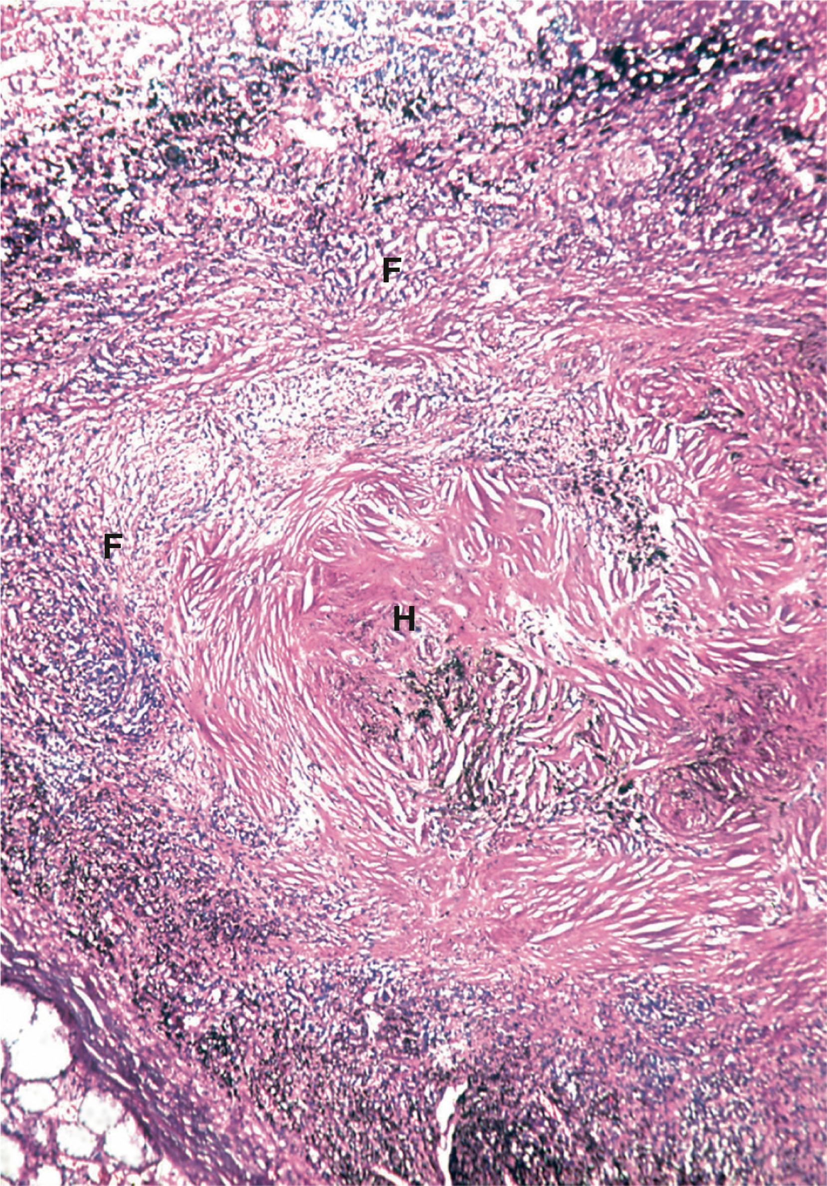 E-Fig. 12.7, Silicosis (MP)