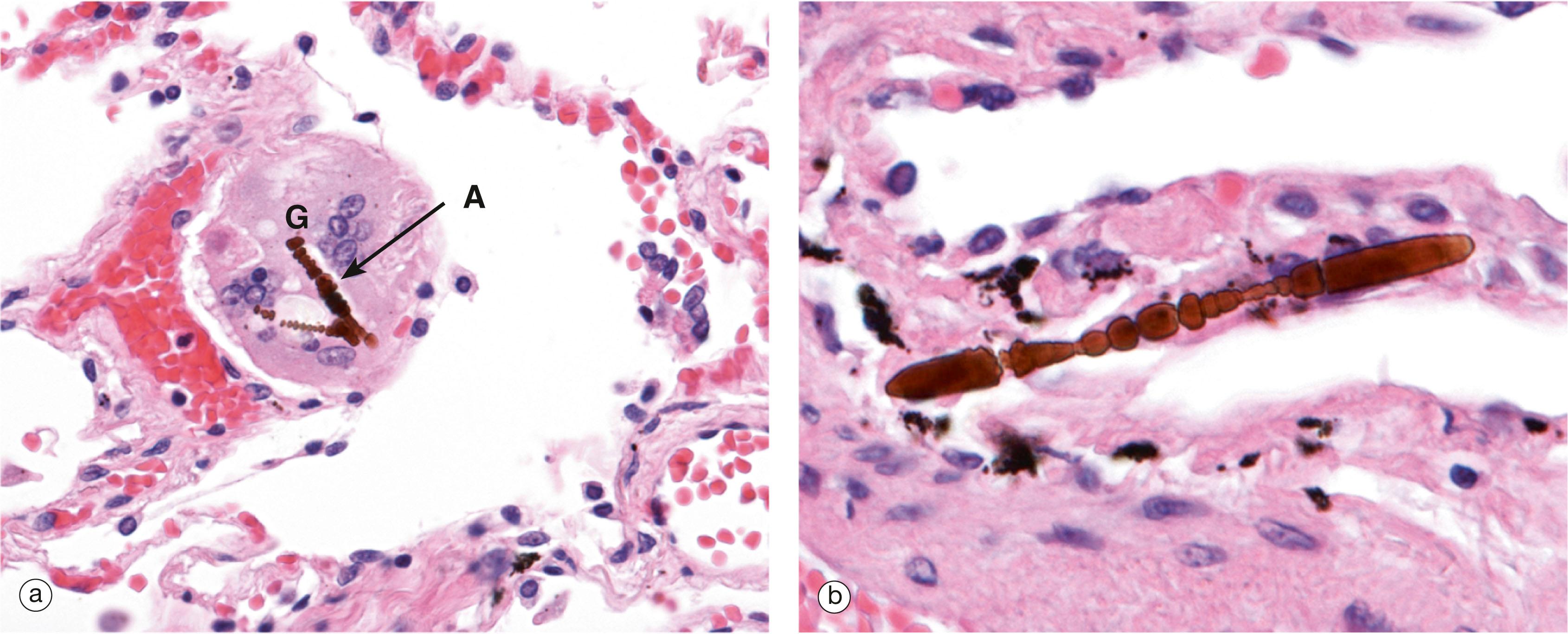 E-Fig. 12.8, Asbestosis