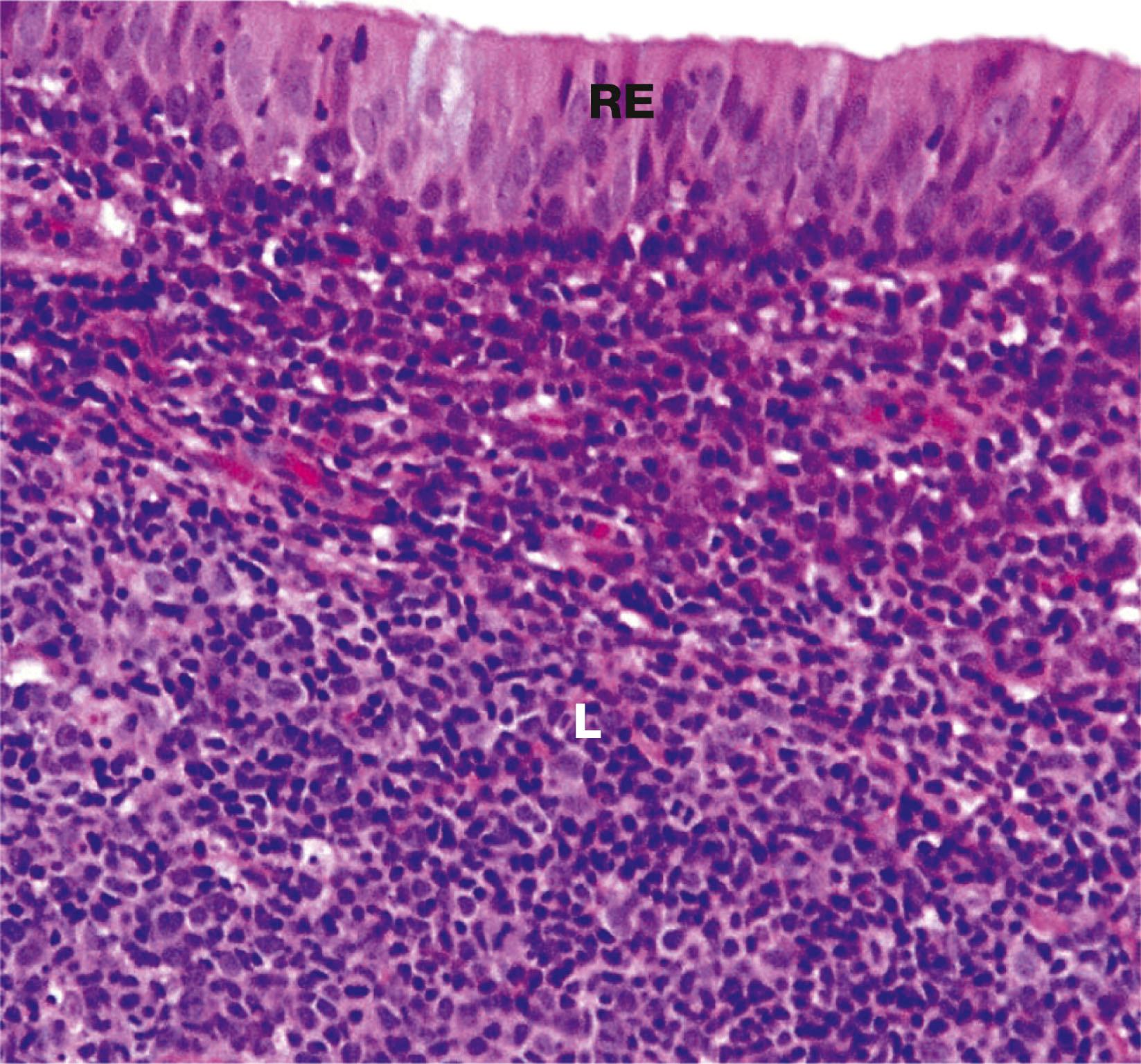 Fig. 12.4, Nasopharynx