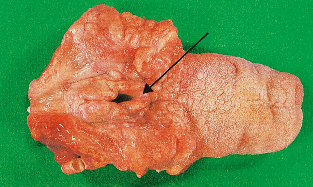 Fig. 14.4, Acute epiglottitis.