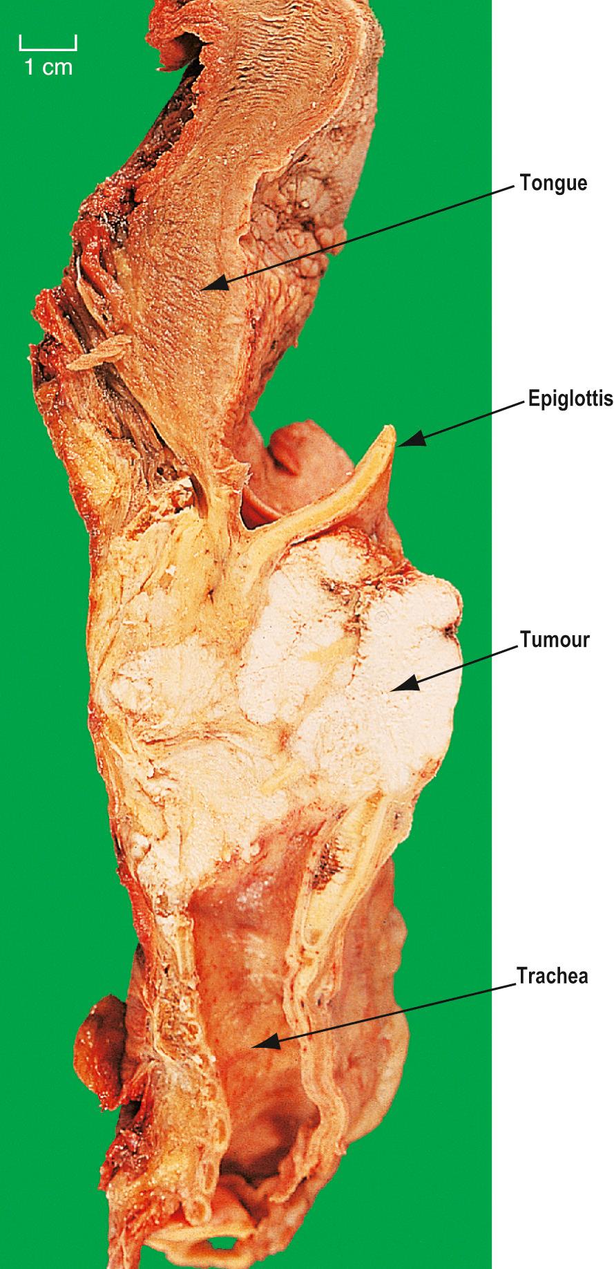 Fig. 14.5, Laryngeal carcinoma.