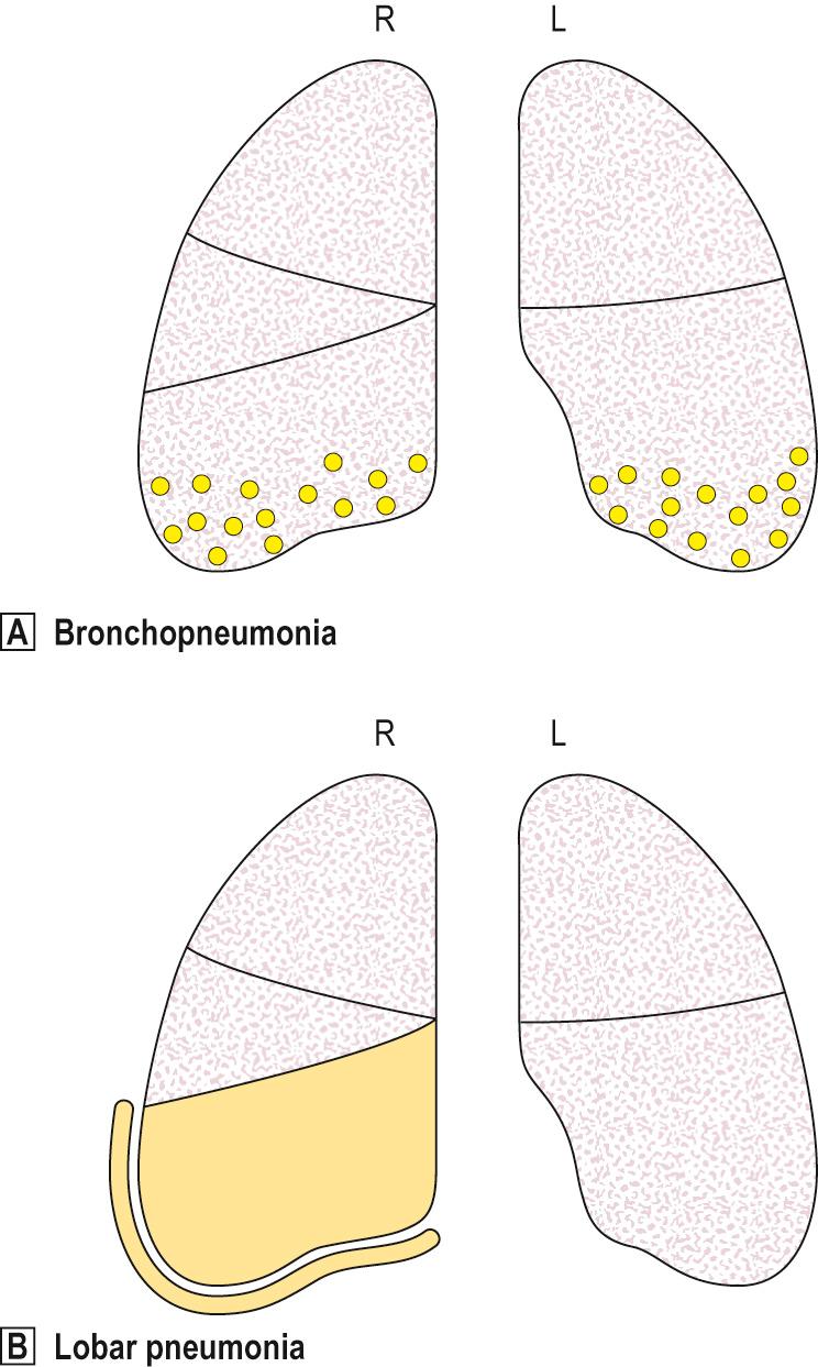 Fig. 14.6, Distribution of lesions in lobar pneumonia and bronchopneumonia.