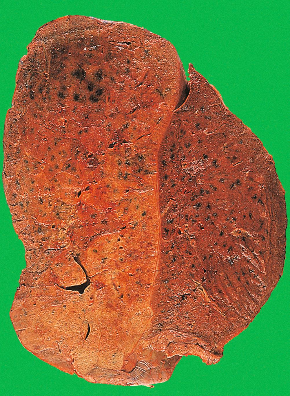 Fig. 14.8, Lobar pneumonia.