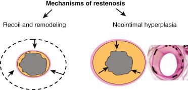 Fig. 34.1, Illustration of the two main mechanisms of restenosis.