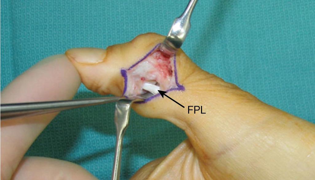 FIGURE 73.2, Via a radial midaxial incision, the FPL tendon ( black arrow ) is identified and the A2 pulley is released. The neurovascular bundle is identified and elevated with the volar skin flap. FPL , Flexor pollicis longus.