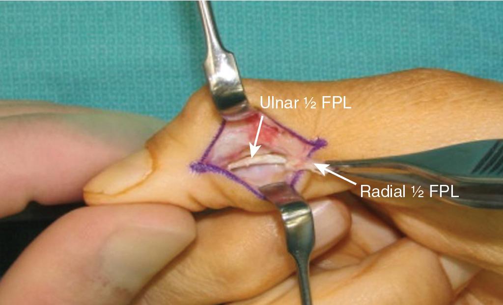 FIGURE 73.3, Radial half of FPL held in forceps is transected and dissected proximally for length. The ulnar half of FPL remains in situ. Note the oblique pulley is left intact. FPL, Flexor pollicis longus.