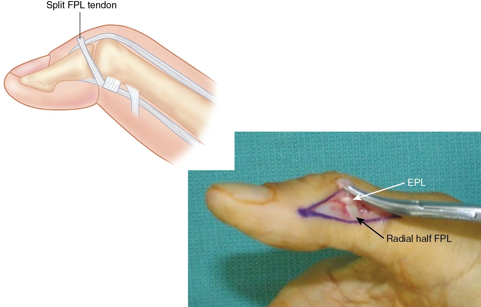 FIGURE 73.4, The radial half of FPL ( black arrow ) is weaved into EPL tendon ( white arrow ) and held to the appropriate tendon. FPL, Flexor pollicis longus.