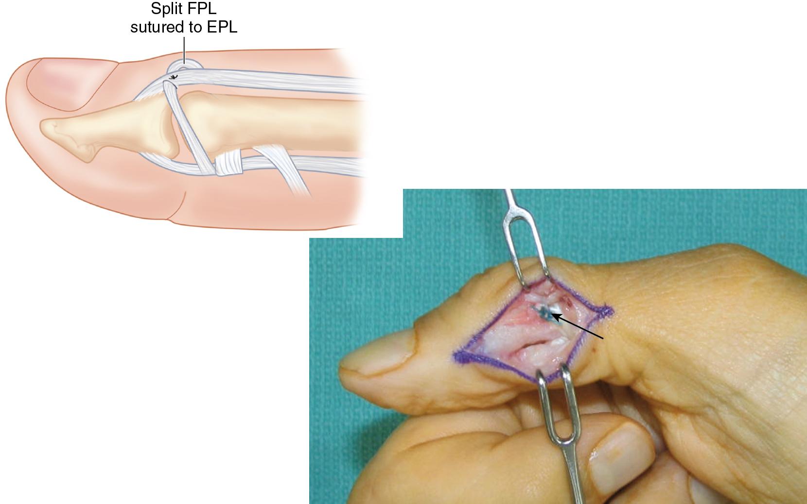 FIGURE 73.5, Pulvertaft weave ( arrow ) of split FPL-to-EPL with nonabsorbable suture. EPL, Extensor pollicis longus; FPL, flexor pollicis longus.