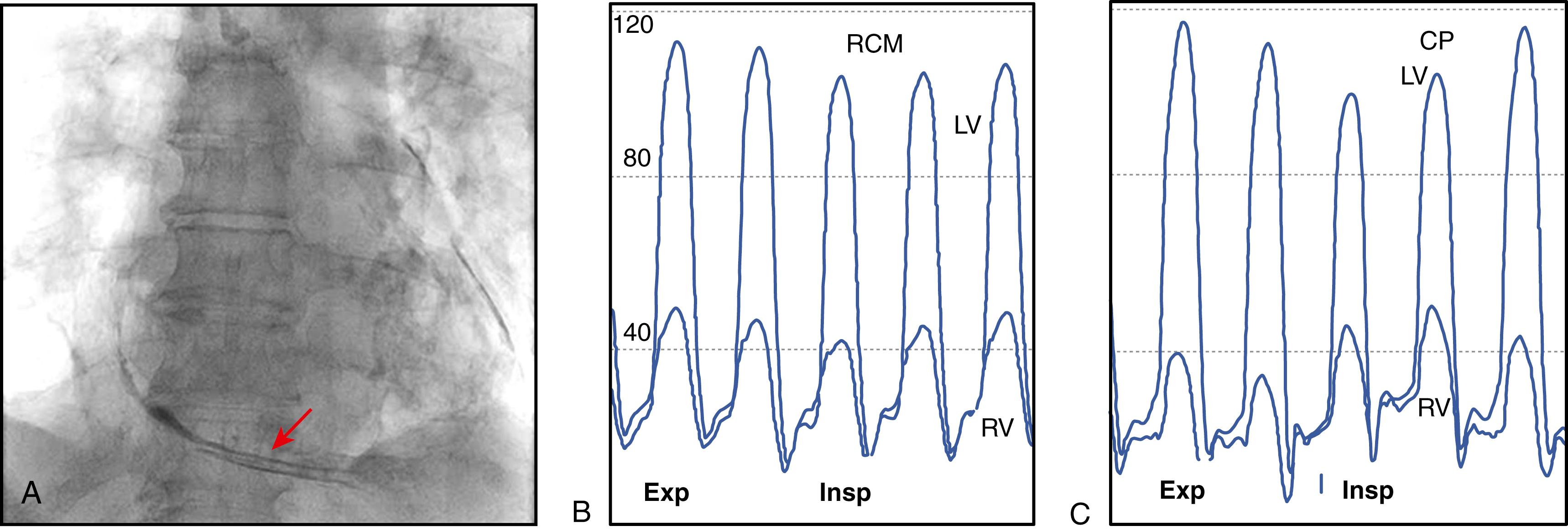 Figure 73.1, A, Fluoroscopy showing calcified pericardium (arrow) in a patient with constrictive pericarditis (CP). B and C, Pressure tracings recorded with high-fidelity manometer-tipped catheters in the left ventricle (LV) and right ventricle (RV) during the respiratory cycle in two different patients: one with restrictive cardiomyopathy (RCM) and the other with CP. B, In this patient with RCM, there are concordant changes in left and right ventricular pressures during inspiration (Insp) and expiration (Exp). This indicates that the elevation of ventricular filling pressures is caused by a myocardial restrictive disease. C, In this patient with CP, there is ventricular discordance, with an increase in right ventricular pressure and a decrease in left ventricular pressure during inspiration and vice versa during expiration. This is caused by the enhancement of ventricular interaction and dissociation of intrathoracic and intracardiac pressures.