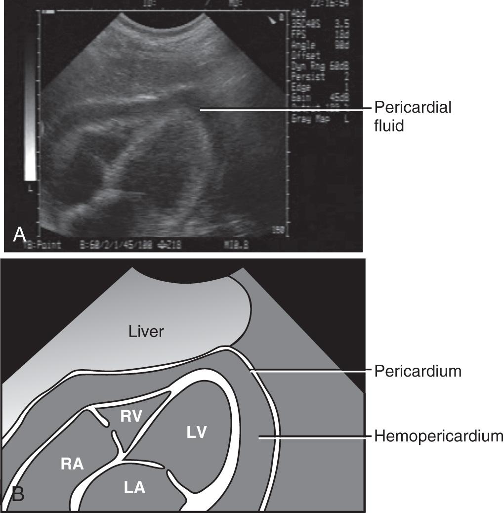 Figure 18.1, A, Bedside ultrasound demonstrating the hemopericardium. B, Artist's drawing of the chambers of the heart, the pericardium, and the hemopericardium as seen on ultrasound. LA, Left atrium; LV, left ventricle; RA, right atrium; RV, right ventricle.