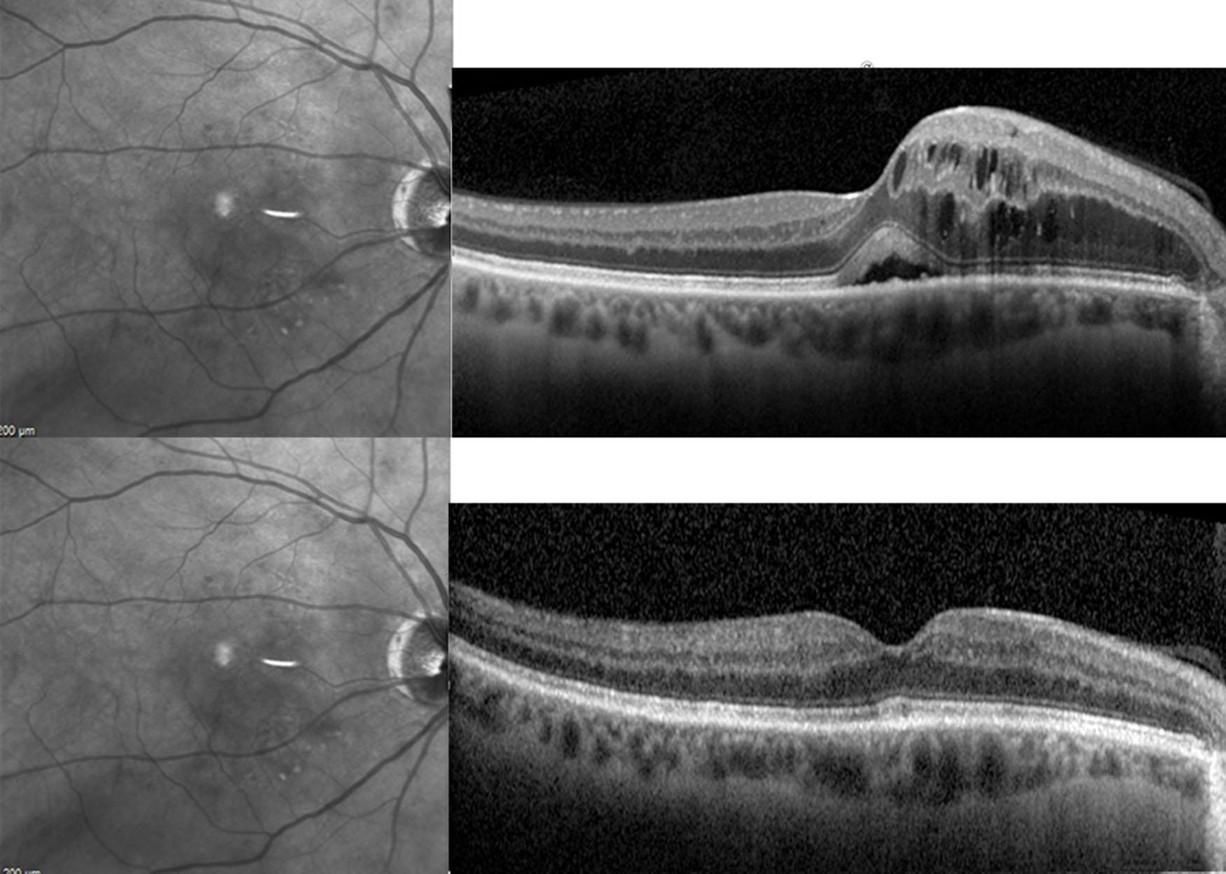 Fig. 39.3, 57 year-old female with poor glycemic control, severe NPDR OU and DME OD. VA was 20/40. SD-OCT (upper right) with infrared image (upper left) showing moderate macular edema with presence of SRF. After 3 injections of anti-VEGF therapy, vision improved to 20/20 and DME resolved. SD-OCT after treatment (bottom right) shows resolution of macular edema and subretinal fluid.
