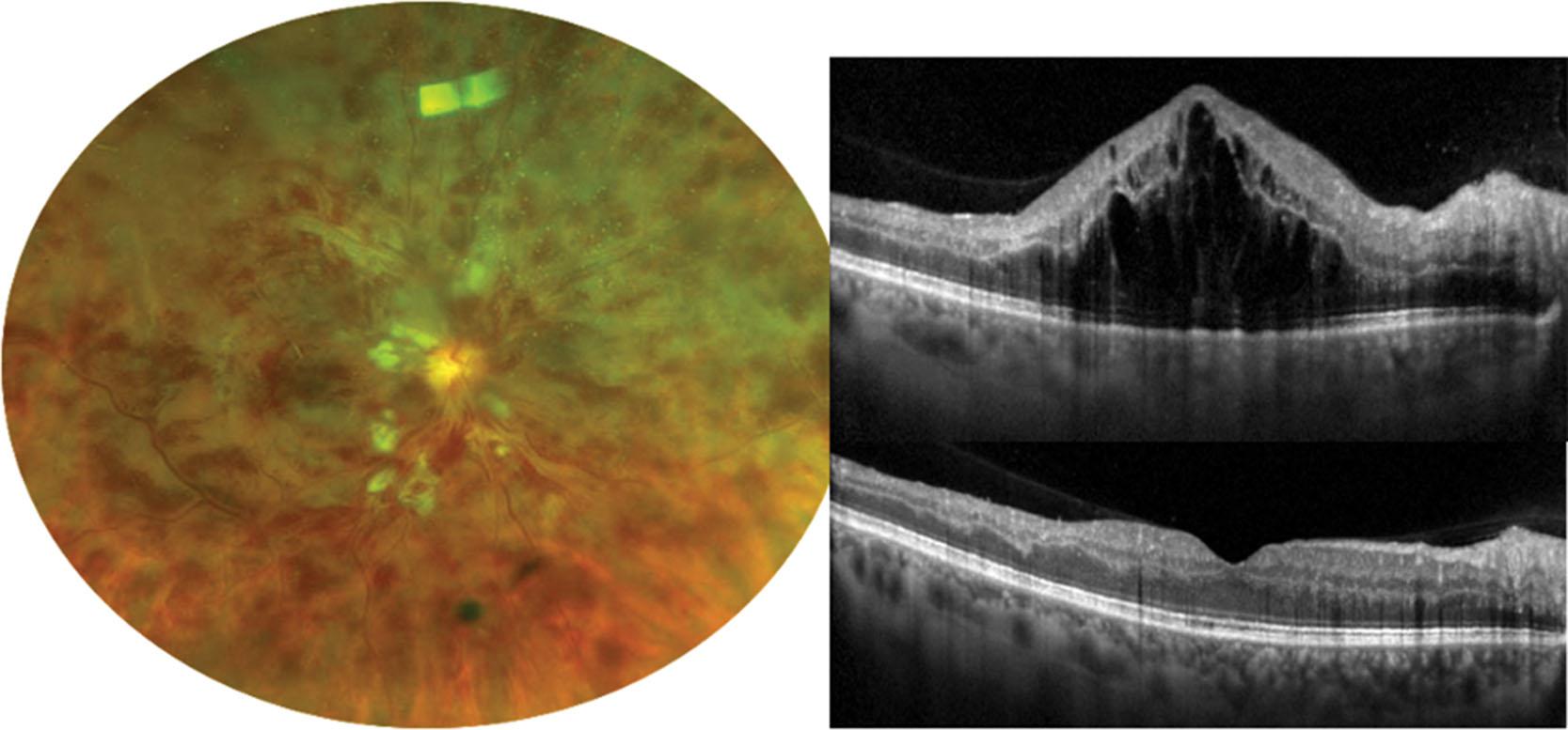 Fig. 39.4, A 52-year-old male with newly diagnosed central retinal vein occlusion OD presenting with initial VA of CF that improved to 20/40 after three intravitreal anti-VEGF treatments. ( Left ) Color fundus photograph demonstrating diffuse intraretinal hemorrhage and cotton wool spots associated with vascular tortuosity. (Upper right) SD-OCT showing severe cystoid macular edema (CME). ( Lower right ) SD-OCT with resolution of CME after anti-VEGF therapy.