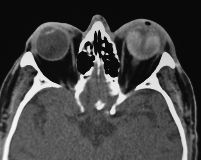 Retinal detachment Clinical Tree