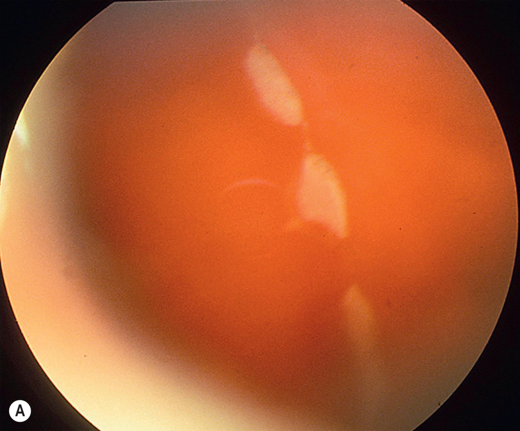 Fig. 51.1, Retinal dialysis. (A) Traumatic 180 degree “bucket handle” avulsion non-pigmented pars planar epithelium from patient in Fig. 51.2 . (B) Non-traumatic retinal dialysis. Note characteristic associated cystic oral frill (arrowhead) and trans-dialysis tissue bridges (arrow).