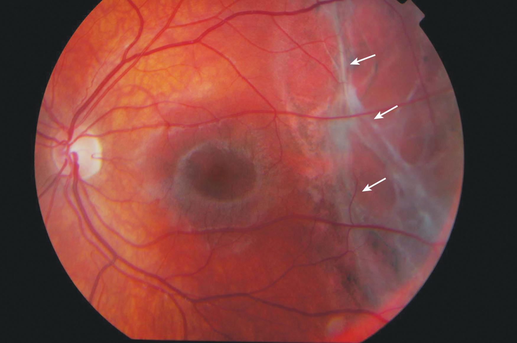 Fig. 51.3, Traumatic retinal dialysis associated with chronic retinal detachment in an 11-year-old girl. The peripheral dialysis is not shown but the bands of subretinal fibrosis (arrows) rarely require removal via an internal approach. Here, the retina was re-attached with a 3 mm circumferential sponge