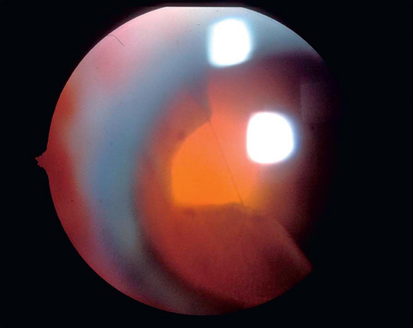 Fig. 51.4, Gravity-induced radial extension at the apex of a giant retinal tear.