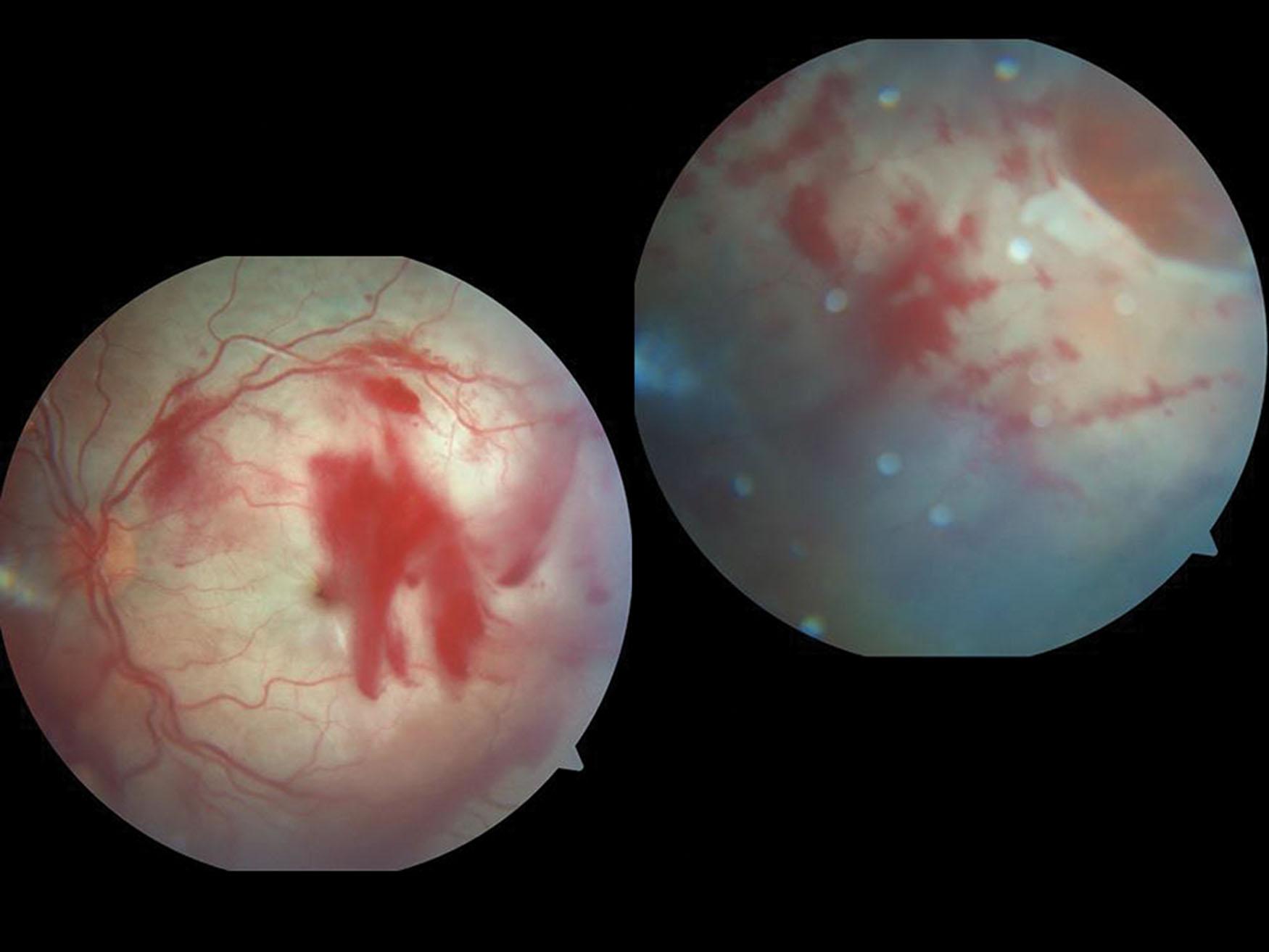 Fig. 51.5, Severe blunt trauma in a 9-year-old boy. Traumatic giant tear in association with posterior pole commotio retinae and ragged impact necrotic breaks.